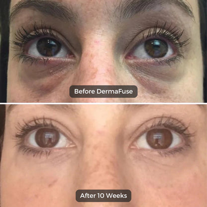 Skinwise™  Micro needle Eye patches