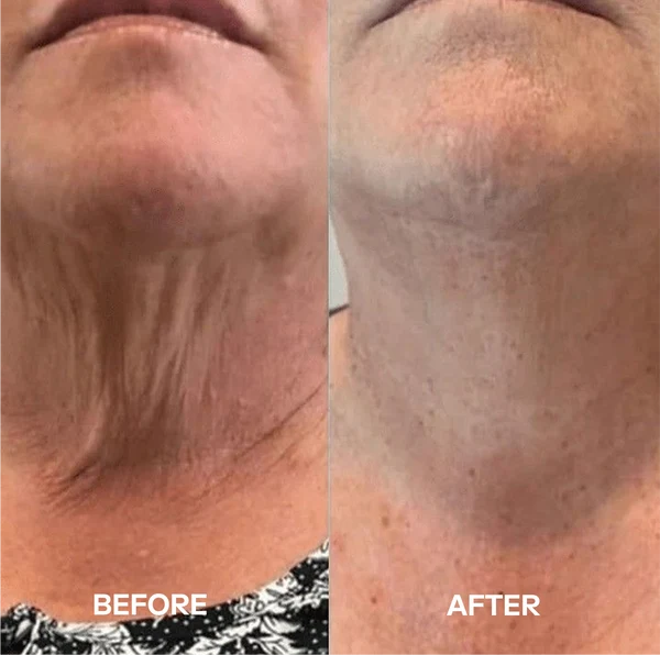 Skinwise™ Bio-Collagen Neck Mask